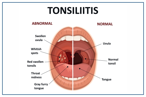 TonsillitisMythsVsFacts.jpg